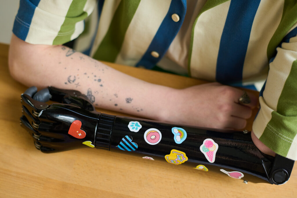 Close up of a decorated prosthetics arm covered in colorful stickers during daily use.