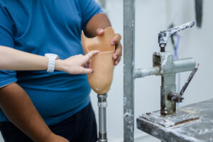 Patient walking with therapist during rehabilitation session focused on prosthetic care and mobility improvement